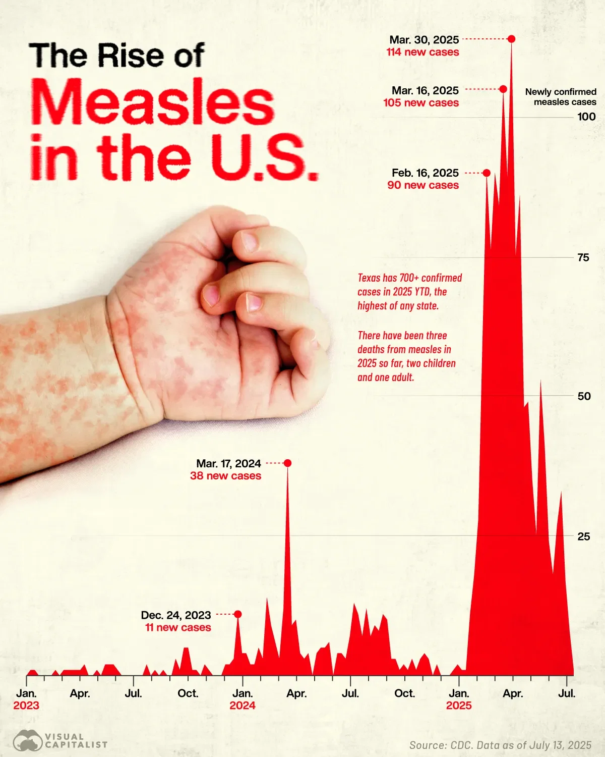 2025's Surge of Measles Cases in the U.S. 🦠