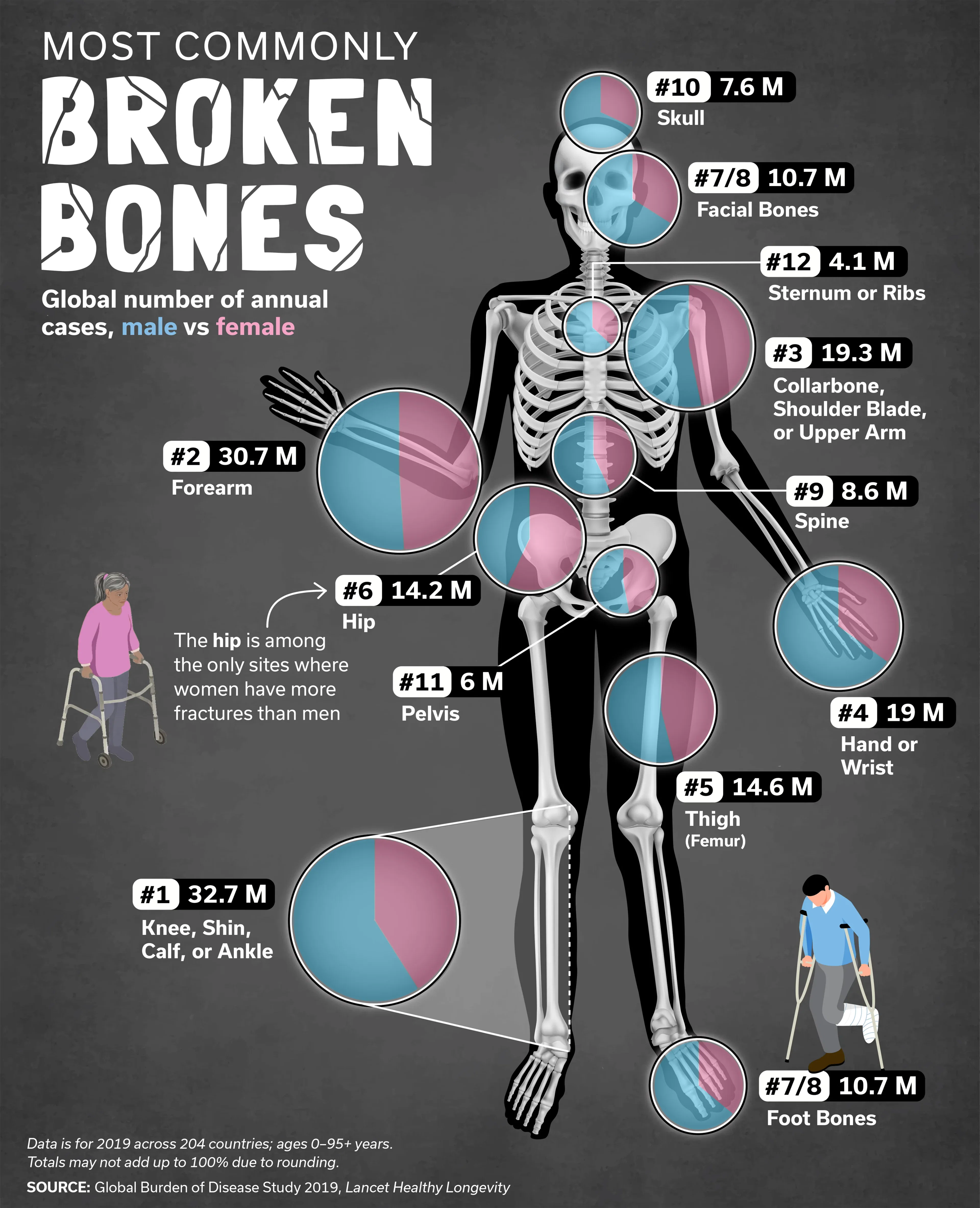 Most Commonly Broken Bones